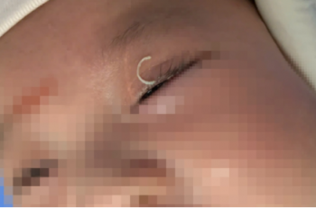 Mẹ c:;ắt móng tay văng vào mắt, cháu bé 2 tháng tuổi l:âm ng:uy