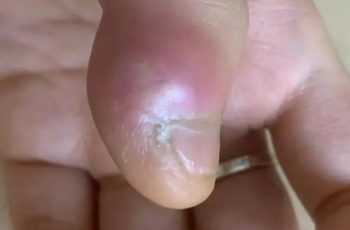 Cậu bé suýt bị c/;ắt c;ụt chi chỉ vì cắn móng tay thường xuyên