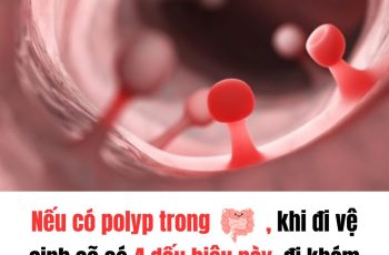 Nếu có polyp trong ru:ột, khi đi vệ sinh sẽ có 4 dấu hiệu này, đi khám ngay kẻo muộn